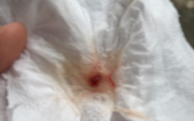 Close up of crumpled loo paper sheet with a slighty blood stained jelly-like substance in the centre