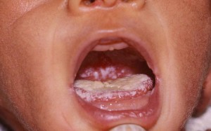 Close up of baby's open mouth showing white patches of thrush