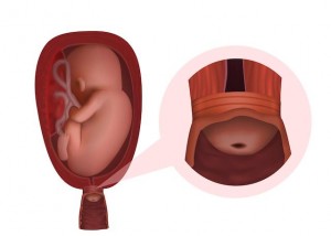 Short cervix in pregnancy illustration