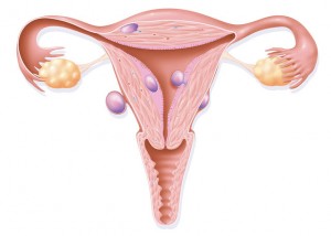 Drawing of uterus showing fibroids which have grown inside and outside of it