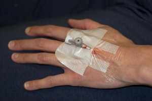 Cannula in back of hand
